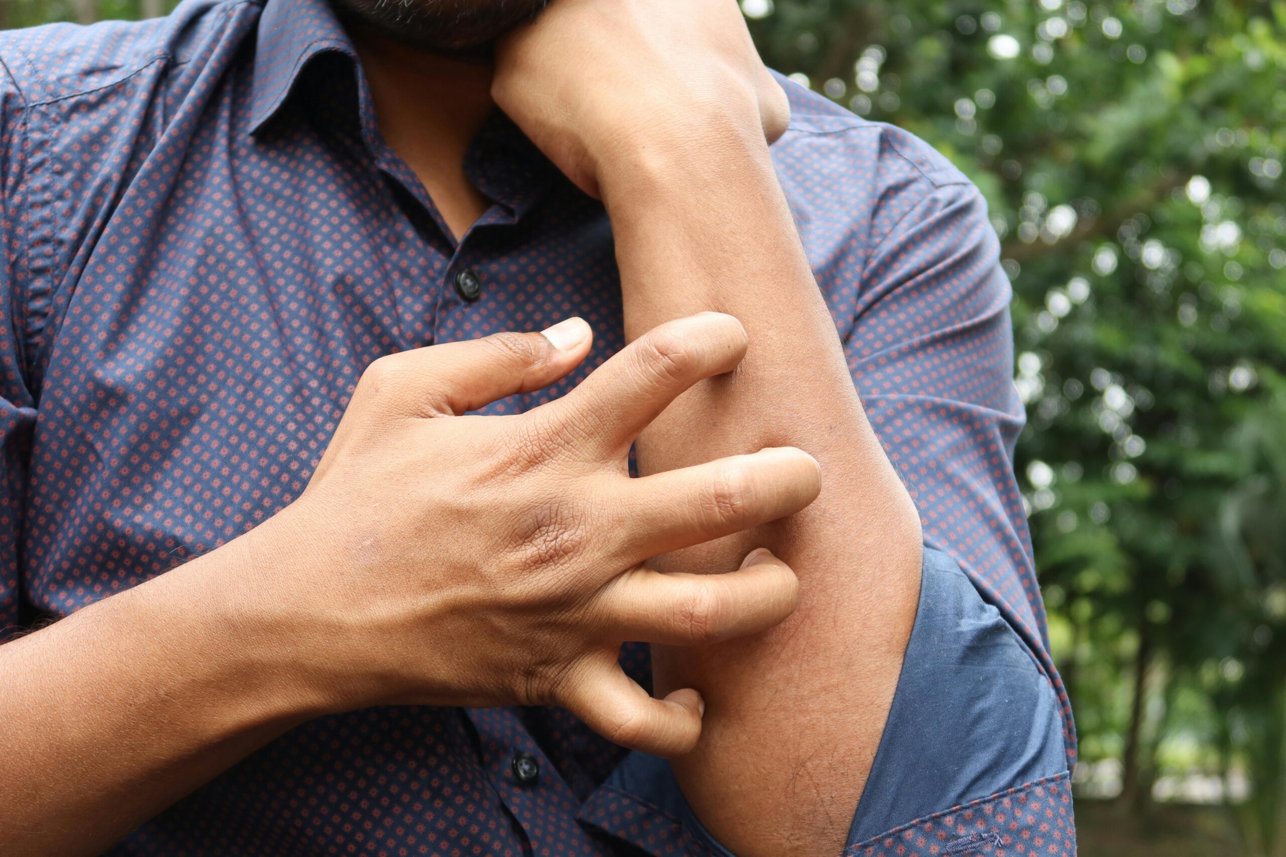 A man in a blue shirt scratching his arm outdoors, highlighting skin irritation.