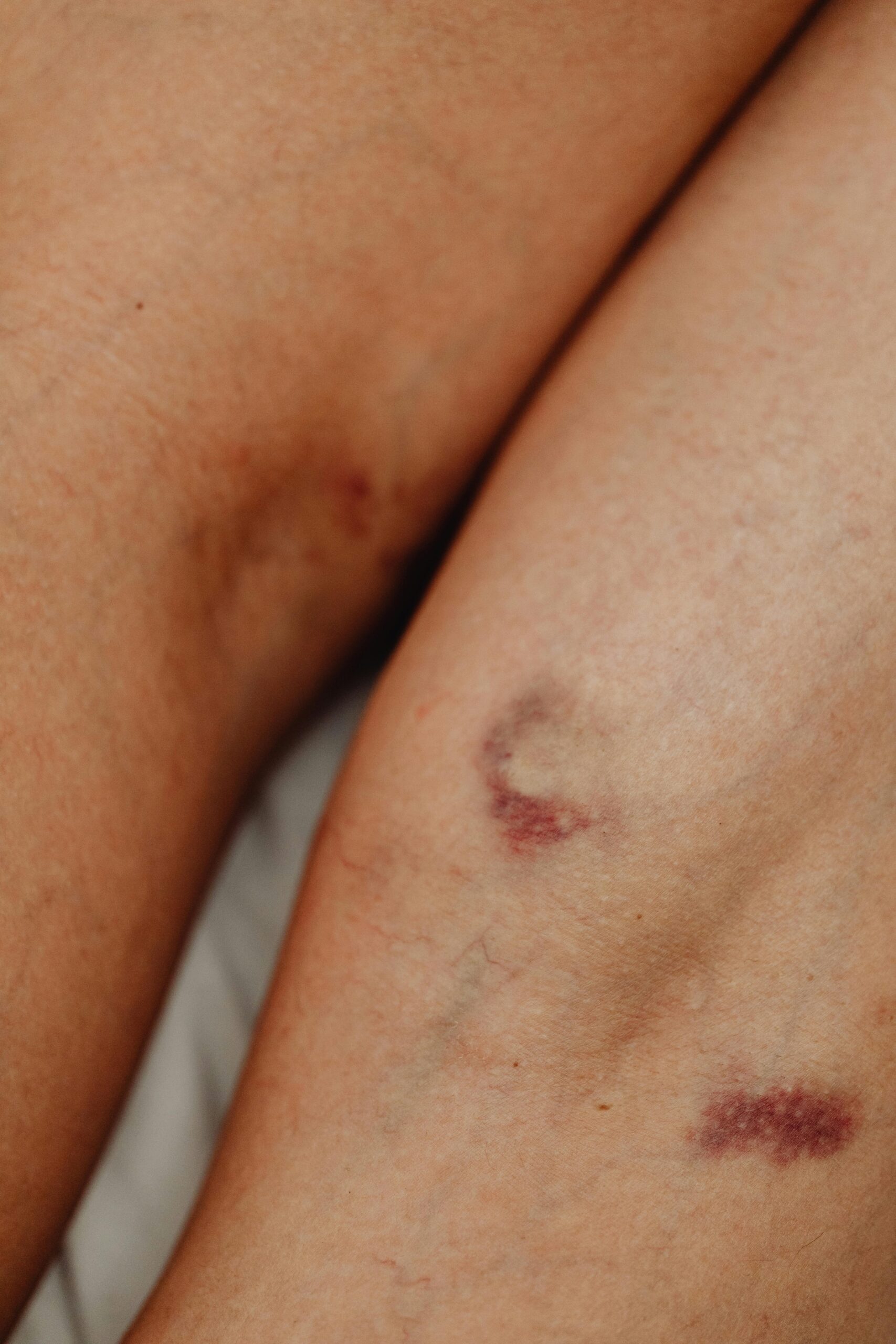 Detailed close-up of human skin showing bruises and imperfections, highlighting natural texture.
